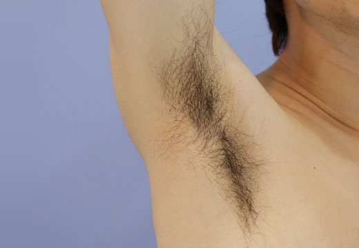 男性脱毛 ワキ 症例写真 剃毛前 (未照射の状態)