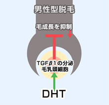 男性型脱毛