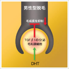 男性型脱毛