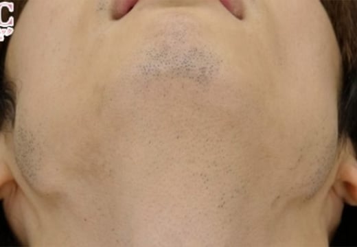 男性脱毛 ヒゲ02 症例写真 1回目照射から1か月後（剃毛していない状態）