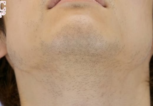男性脱毛 ヒゲ02 症例写真 剃毛前 (未照射の状態)