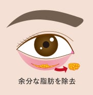 目の下の切らないクマ取り・たるみ(ふくらみ)取り 傷跡 イメージ