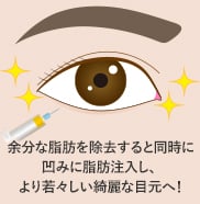 目の下の切らないクマ取り・たるみ(ふくらみ)取り+脂肪注入 傷跡 イメージ