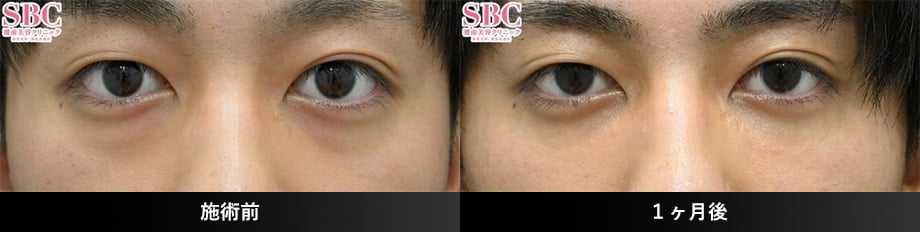 20代症例写真