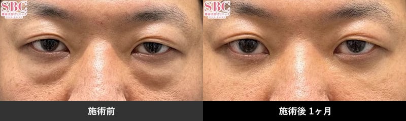 施術前 施術後１ヶ月後