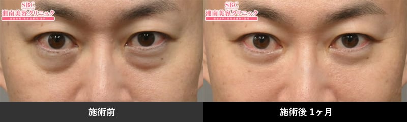 施術前 施術後１ヶ月後