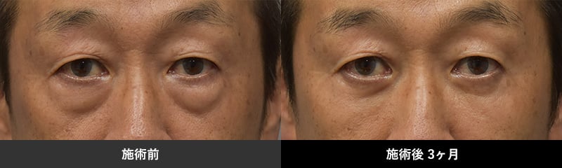 施術前 施術後３ヶ月後