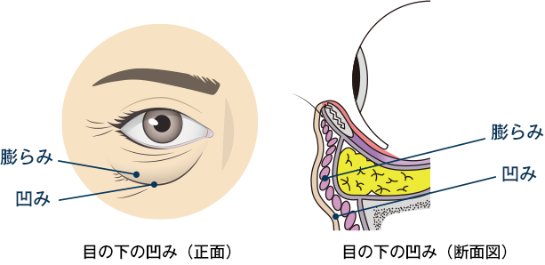 目の下は膨らみと凹みが混在