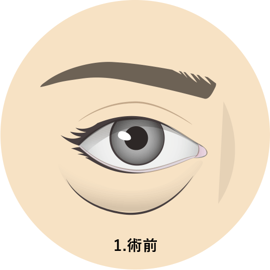 目の下のクマ・ふくらみの様子