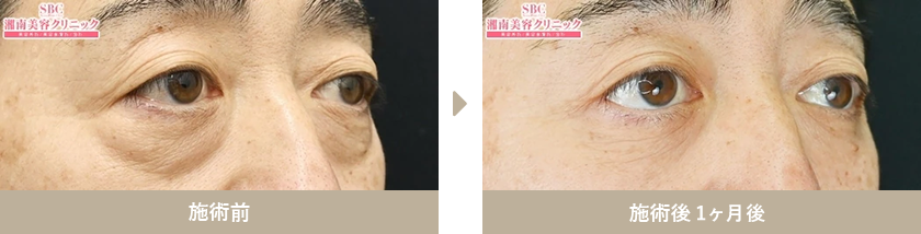 施術前 施術後１ヶ月