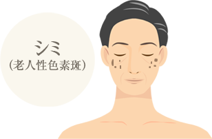 シミ（老人性色素斑）