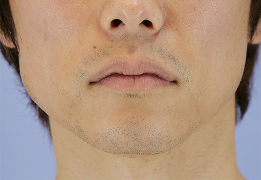 男性脱毛 ヒゲ 症例写真 剃毛前（未照射の状態）