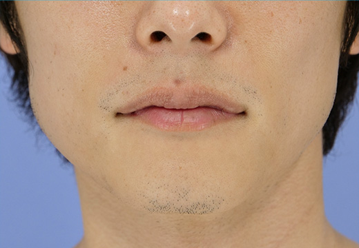 男性脱毛 ヒゲ 症例写真 6回目照射から2か月後（剃毛していない状態）