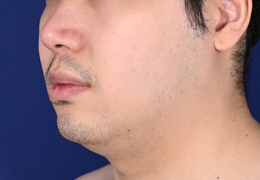 face_03_after.jpg?20251130185534