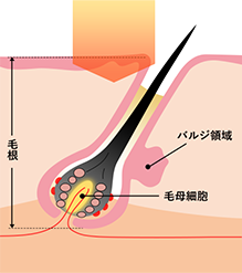 非医療機関の医療脱毛