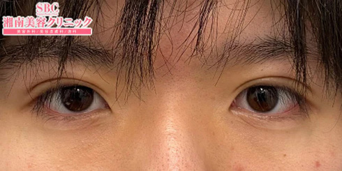 男性の二重の代表的な種類（平行型）