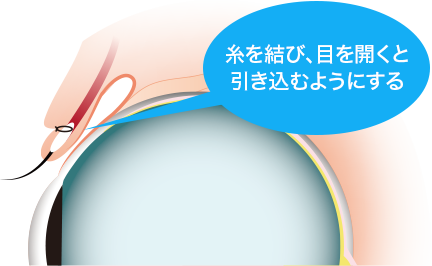 一重まぶた02