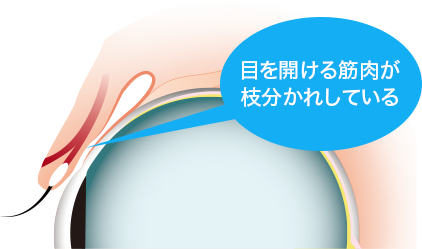 二重まぶた01