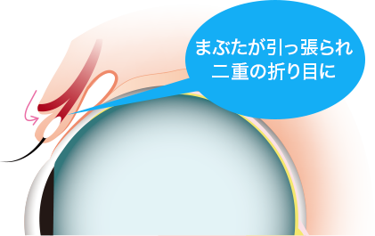二重まぶた02