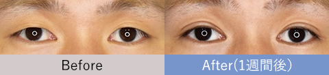 男性の週末二重®の症例写真2
