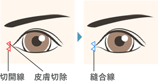 W型