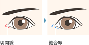 韓流切開法