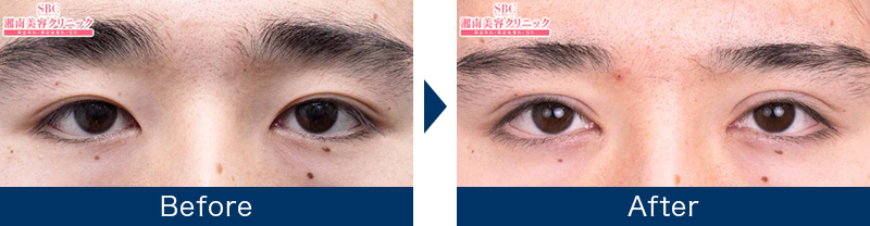 目頭切開プレミアムの症例写真ビフォーアフター3