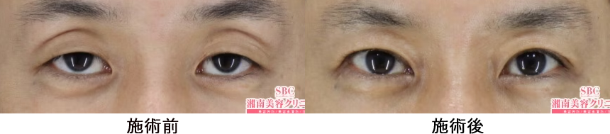 眼瞼下垂の症例写真2