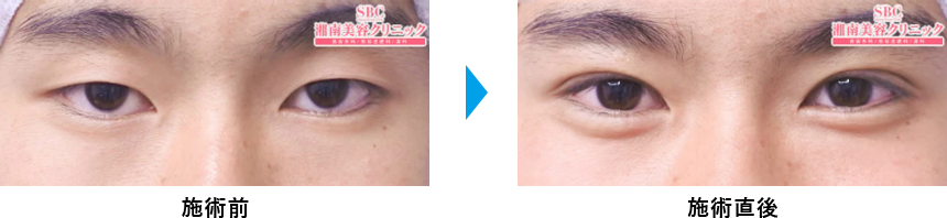 週末二重®の症例写真ビフォーアフター1