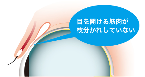 一重まぶたを二重に1