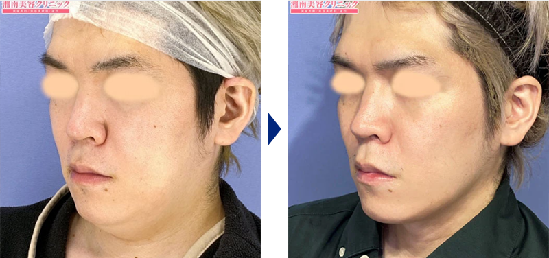 美ボディ脂肪吸引の顔写真ビフォーアフター2