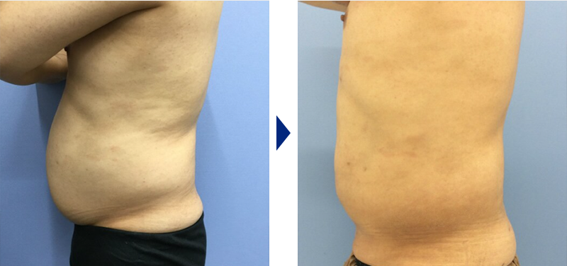 Aquicell（アキーセル）脂肪吸引のお腹写真ビフォーアフター