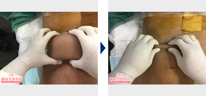 脂肪吸引の左腰写真ビフォーアフター