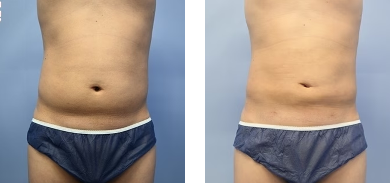 脂肪吸引のお腹写真ビフォーアフター
