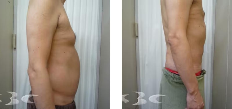 脂肪吸引のお腹写真ビフォーアフター