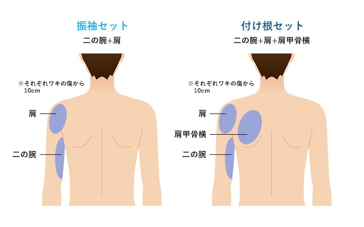 脂肪吸引注射の対象部位(二の腕セット)