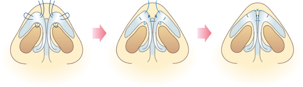 鼻尖形成術とは