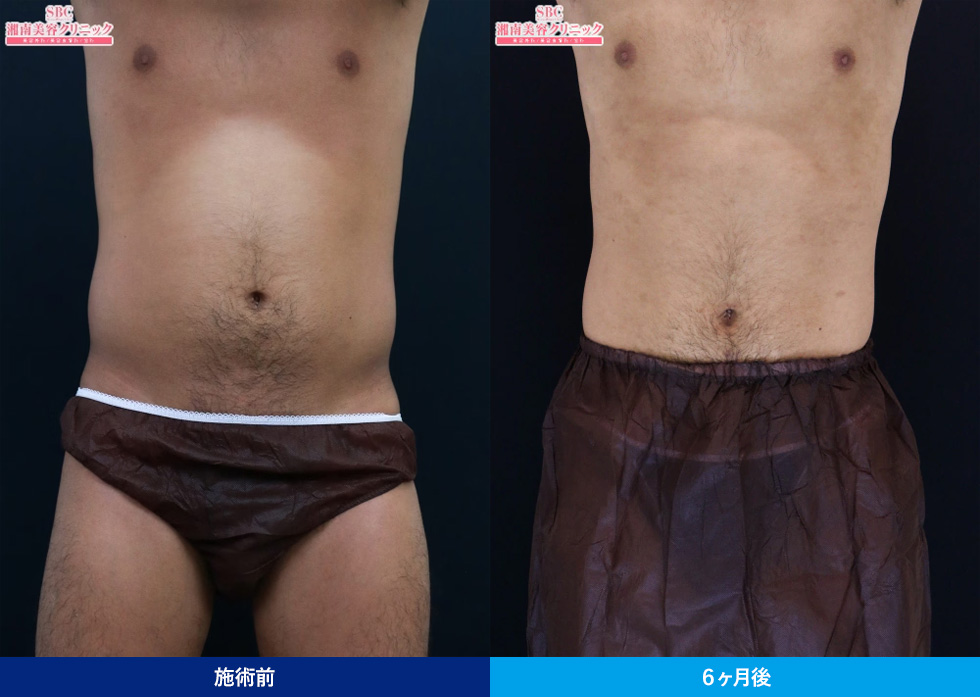 クールスカルプティング®（クルスカ）のお腹の症例写真②