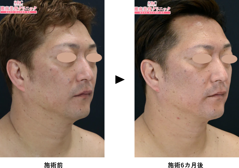 男性（メンズ）のクールスカルプティング®エリート（クルスカダブル）のあご下症例写真ビフォーアフター