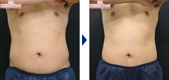 クールスカルプティング®エリート（クルスカダブル）/サクセンダの上半身症例写真ビフォーアフター