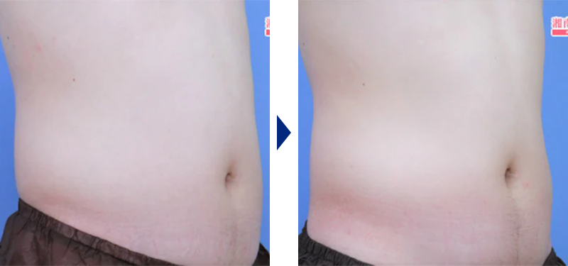 トゥルースカルプiDお腹症例写真ビフォーアフター