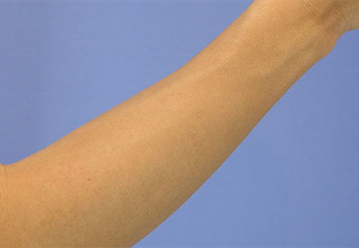 男性脱毛　腕(両ひじ下)　症例写真　2回目照射から2ヵ月後剃毛前