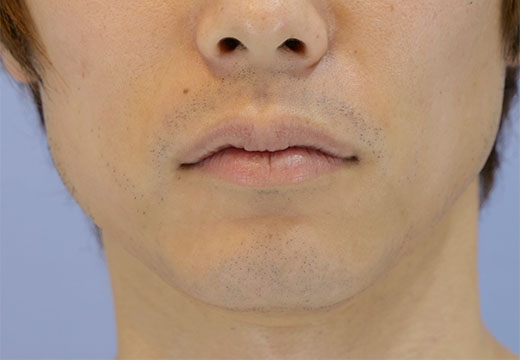 男性脱毛 ヒゲ 症例写真 1回目照射直後