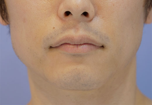 男性脱毛　ヒゲ　症例写真　1回目照射から2ヵ月後剃毛前