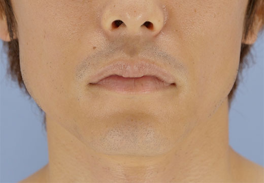 男性脱毛　ヒゲ　症例写真　3回目照射から2ヵ月後剃毛前