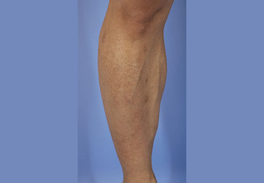 男性脱毛　脚(両ひざ下)　症例写真　1回目照射から2ヵ月後剃毛前