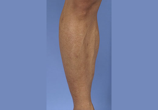 男性脱毛　脚(両ひざ下)　症例写真　2回目照射から2ヵ月後剃毛前