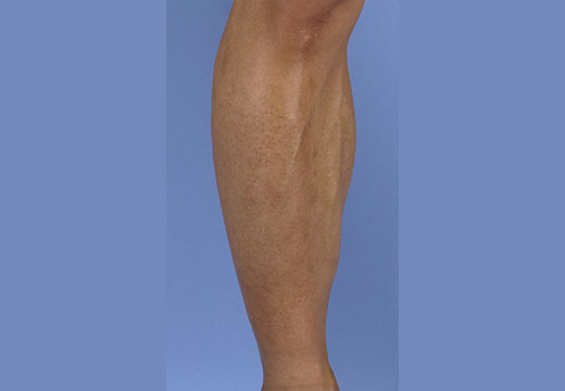 男性脱毛　脚(両ひざ下)　症例写真　3回目照射から2ヵ月後剃毛前