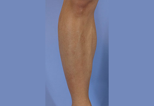 男性脱毛　脚(両ひざ下)　症例写真　4回目照射から2ヵ月後剃毛前