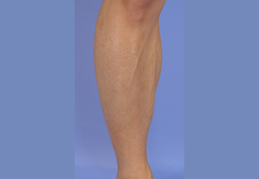 男性脱毛　脚(両ひざ下)　症例写真　5回目照射から2ヵ月後剃毛前